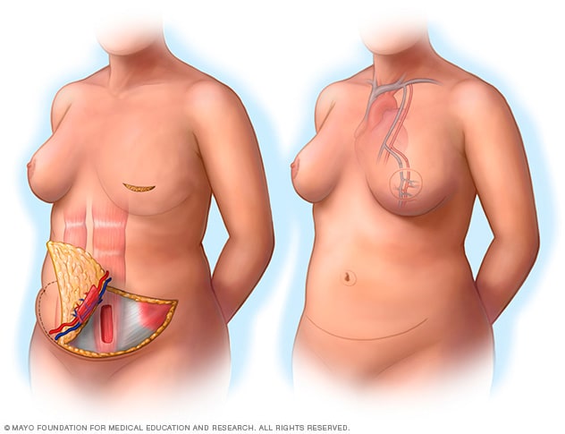 Free TRAM flap procedure
