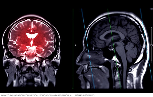 Magnetic resonance imaging (MRI) brain scan showing highlighted areas